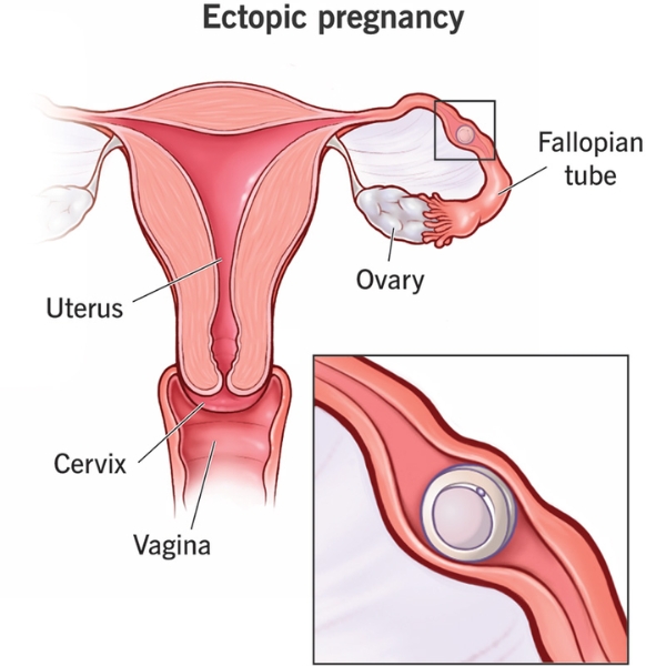 Colposcopy Treatment in Nacharam Hyderabad