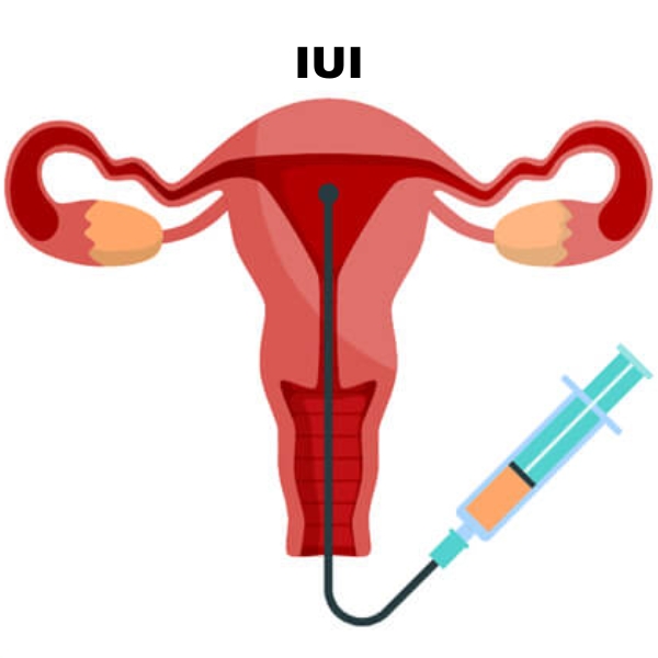 Intrauterine Insemination (IUI) Treatment in Nacharam, Hyderabad